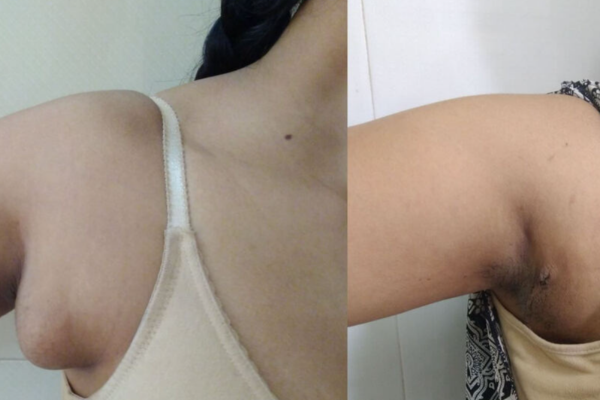 Axillary Breast Surgery