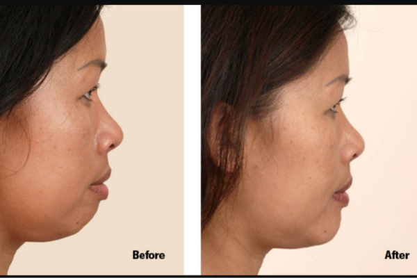 Chin Augmentation