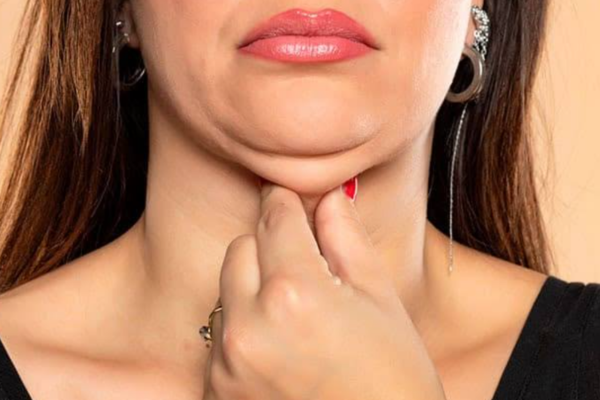 Double chin