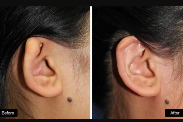 Ear Reconstruction