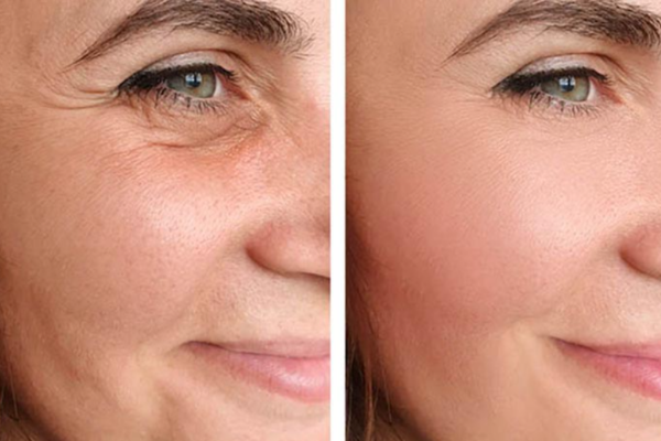 Face Lift