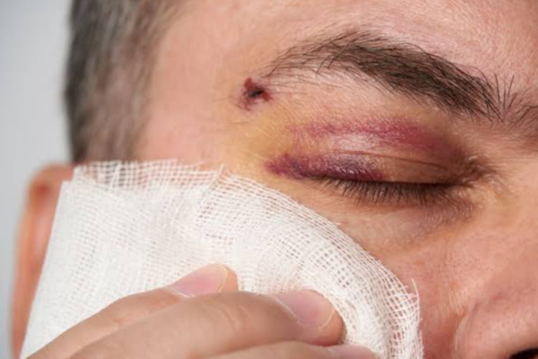 Facial Trauma