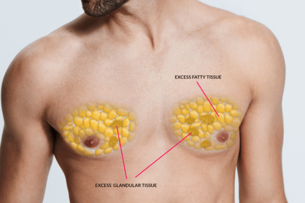 Gynecomastia Treatment