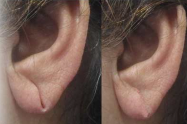 Lobuloplasty