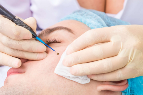 Moles Removal