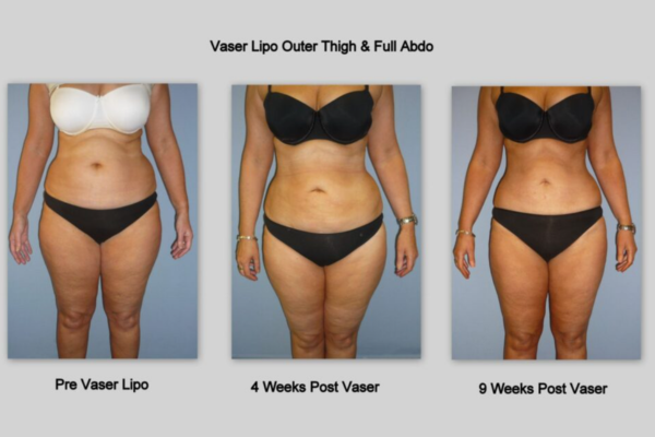 VASER Liposuction