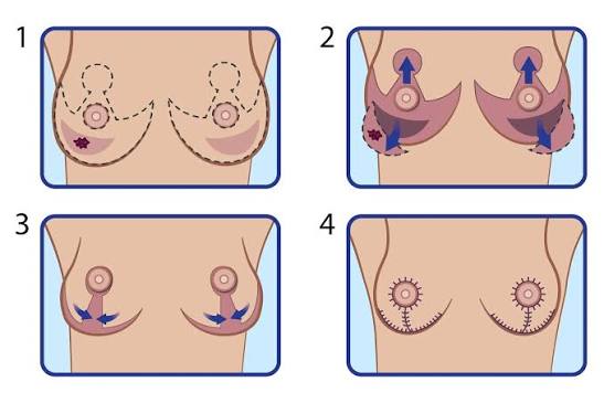 Breast Reduction Surgery In Nagpur