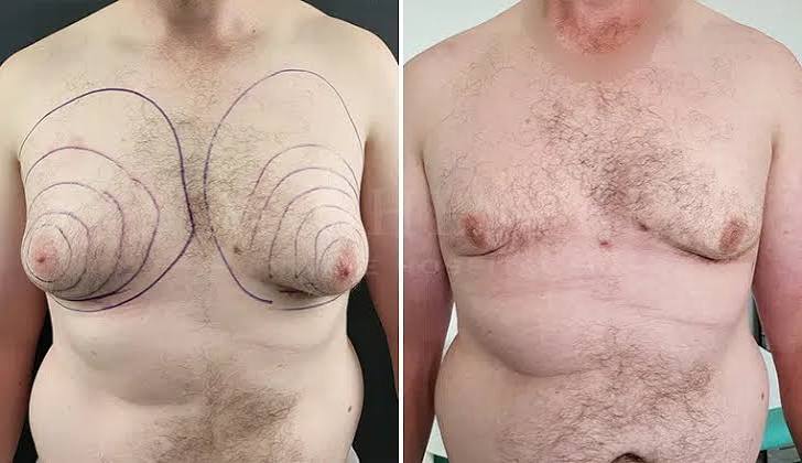 Gynecomastia Surgery In Nagpur