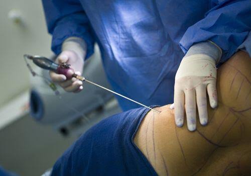 Liposuction Doctor In Nagpur
