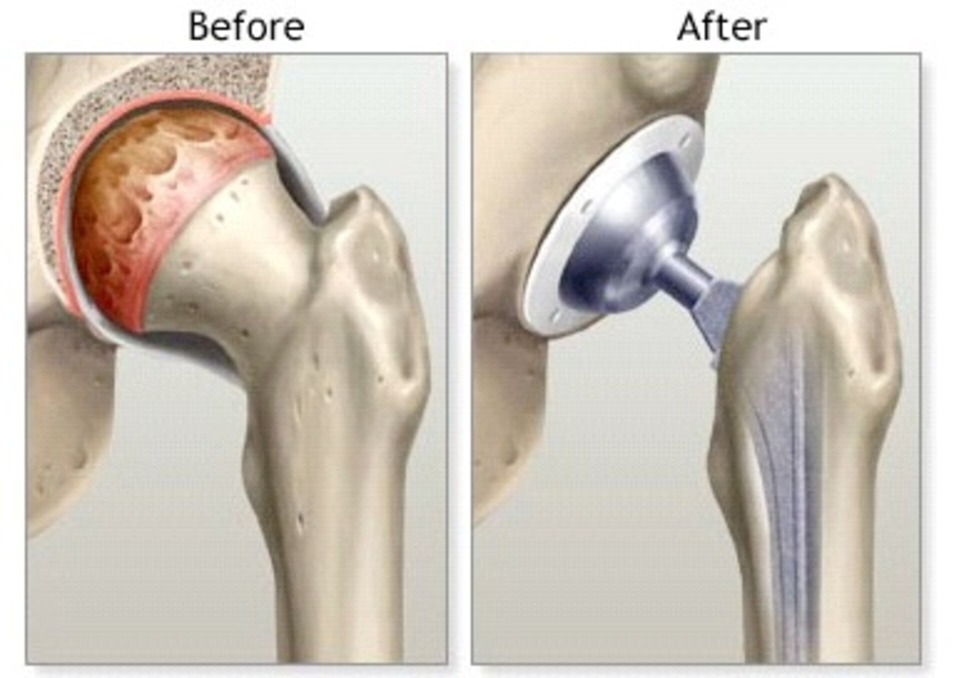 Hip Replacement Surgeon In Nagpur
